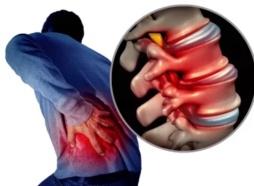 Anterolisthesis-Symptoms-causes-treatment